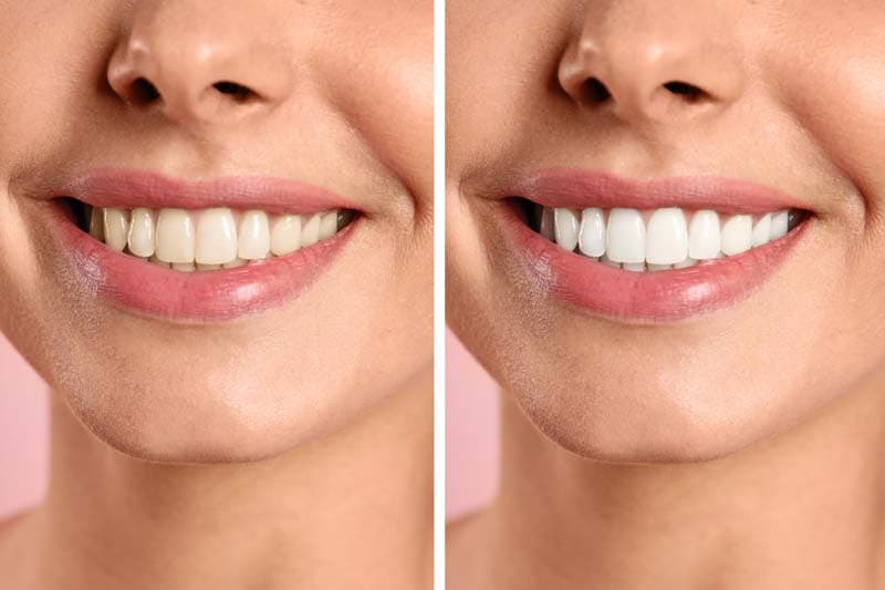 Teeth Stain: Types, Causes & How to Remove Them