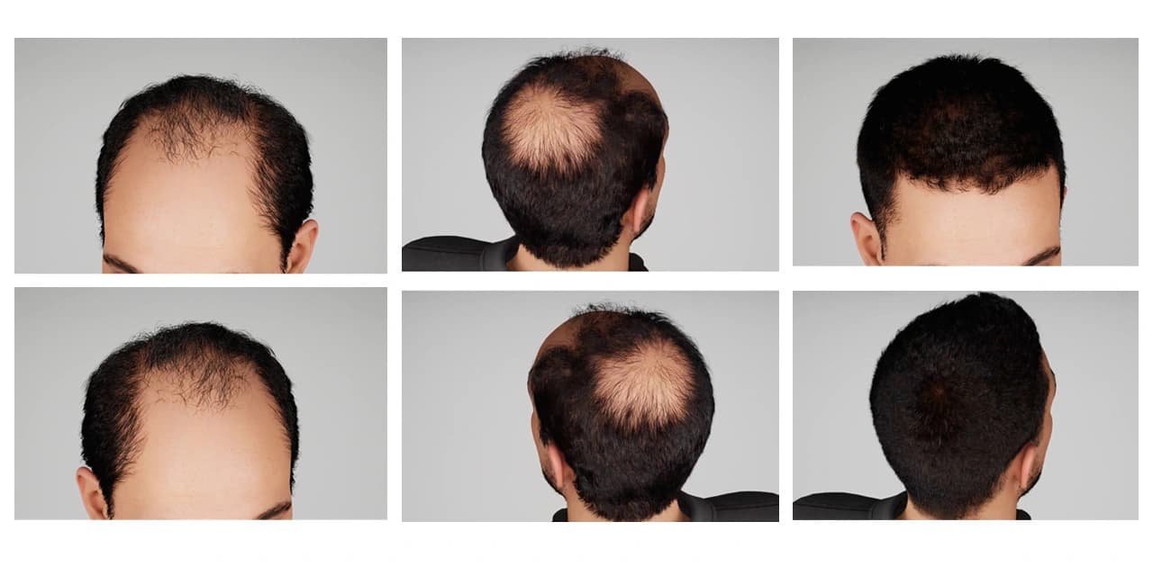 Hair Loss in Men: Causes, Treatment, Diagnosis & Prevention