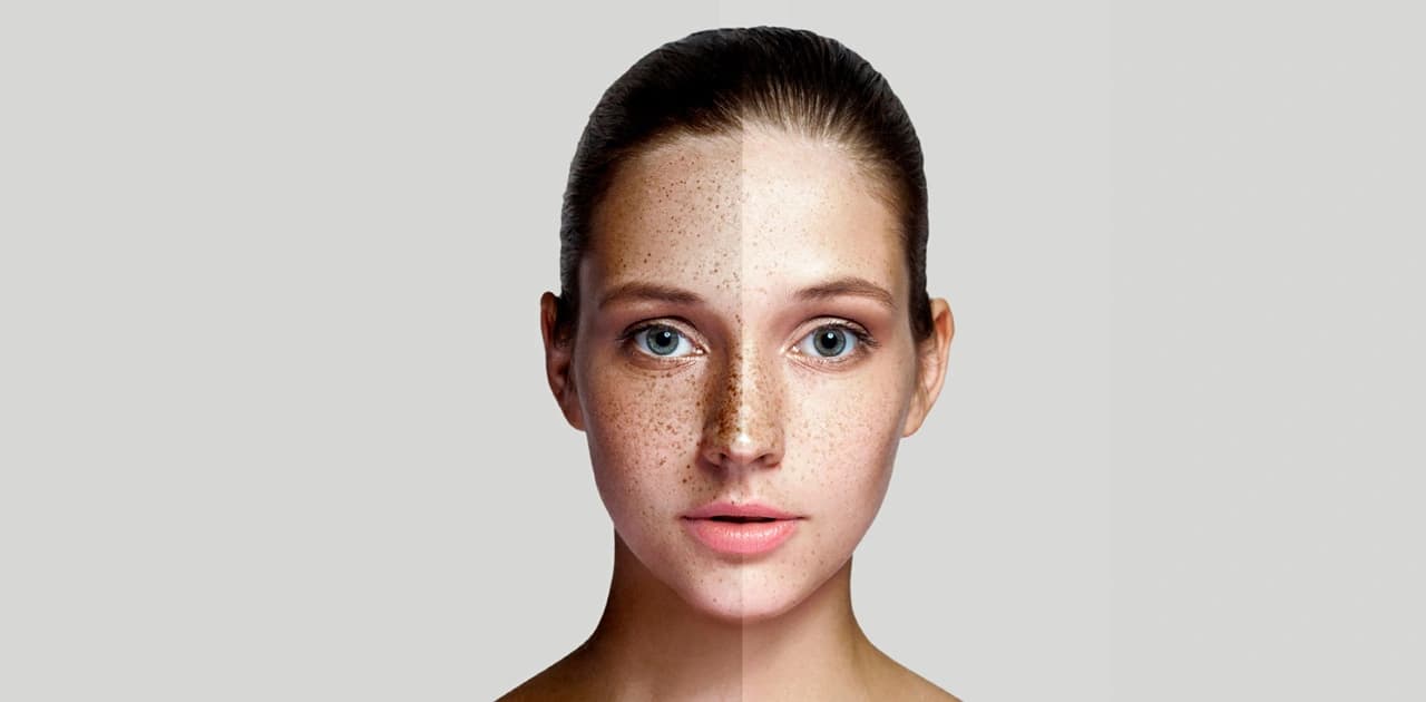 Best Treatment for Melasma: Everything You Need to Know