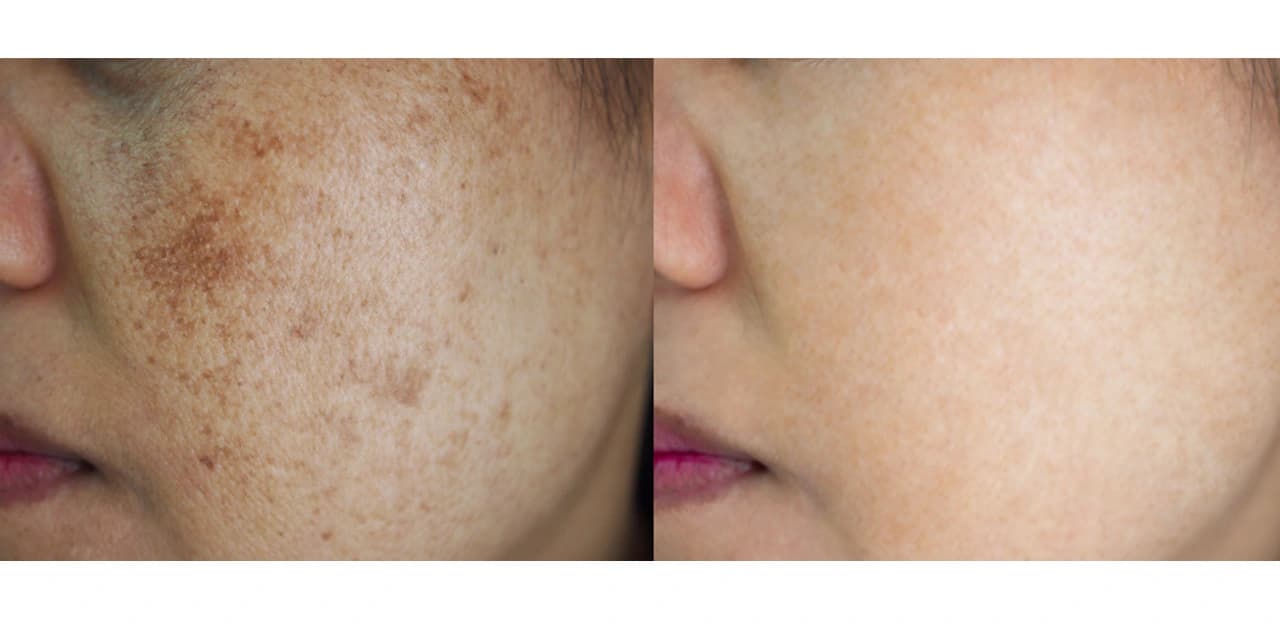 Everything you need to know about age spot treatment