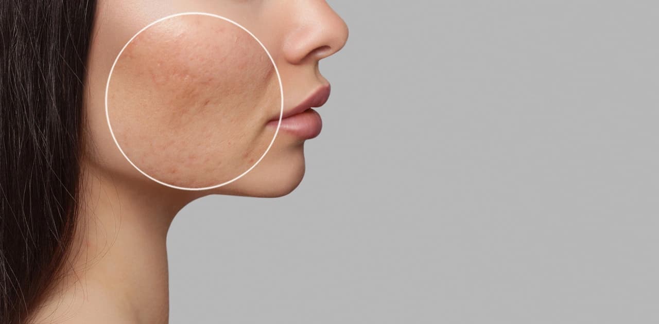 Pimple (Acne) Scars: Causes, Treatment, & Removal