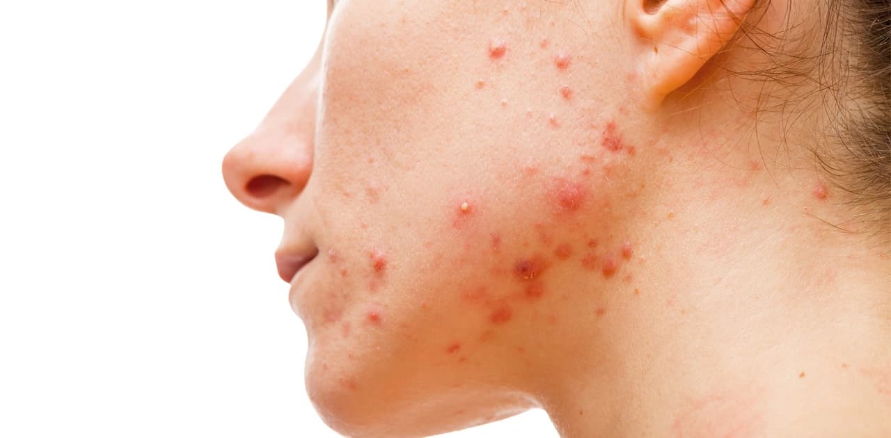 Cyst Pimple (Acne): Treatment, Causes, and Prevention Tips