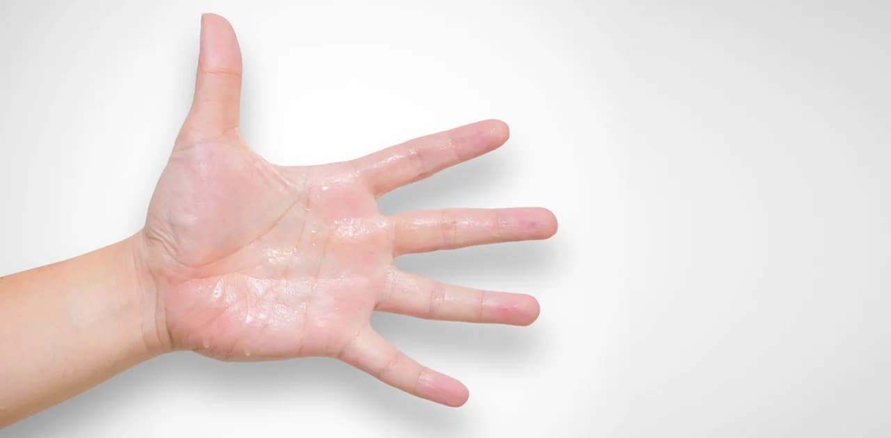 Sweaty Hands Treatment: Solutions for Palmar Hyperhidrosis and Sweaty Palms