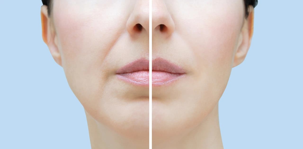 Effective Treatments for Nasolabial Folds (Smile Lines and Laugh Lines)