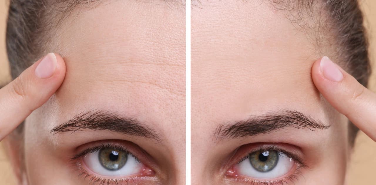Top 5 Forehead Wrinkle Treatments for Smoother Skin