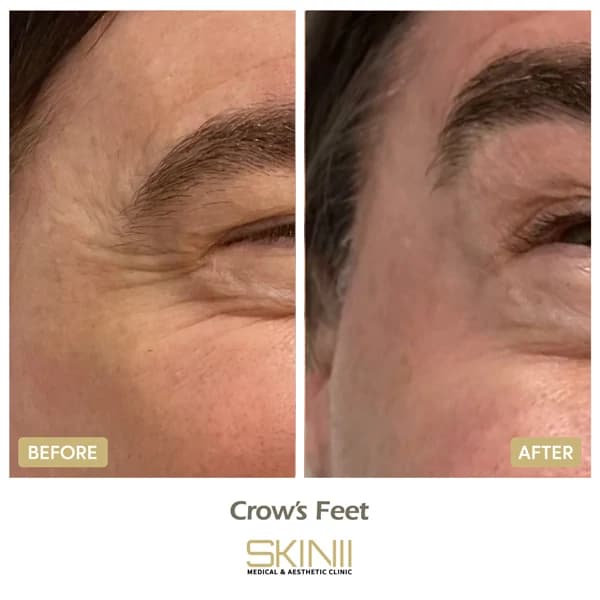 Skin111