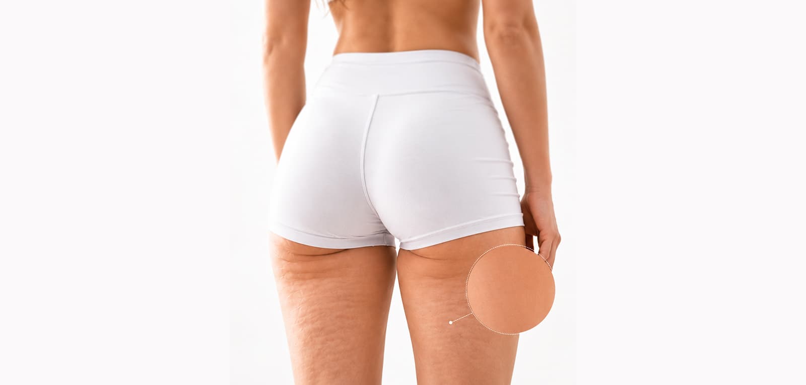 Avéli Cellulite Treatment in Dubai & Abu Dhabi