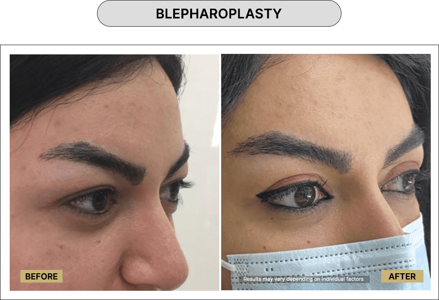 Blepharoplasty