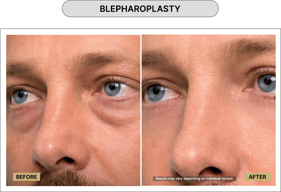 Blepharoplasty