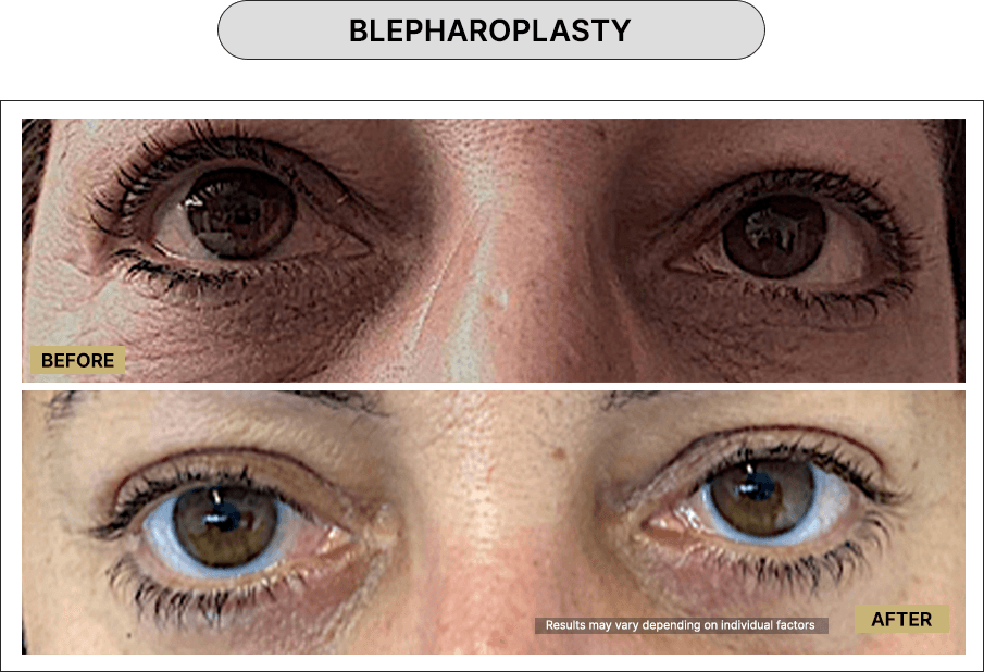Blepharoplasty