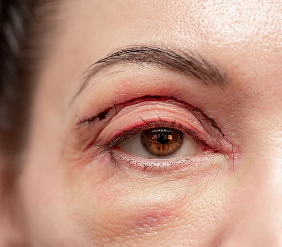 Blepharoplasty
