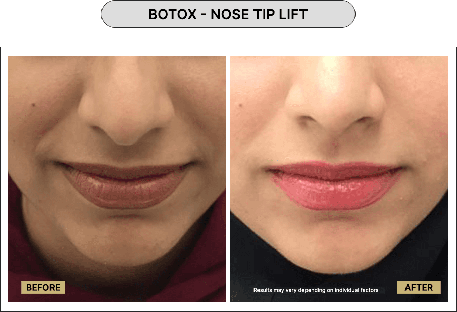 Botox