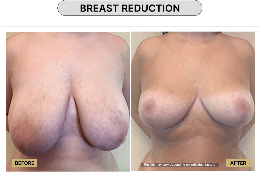 Breast Reduction