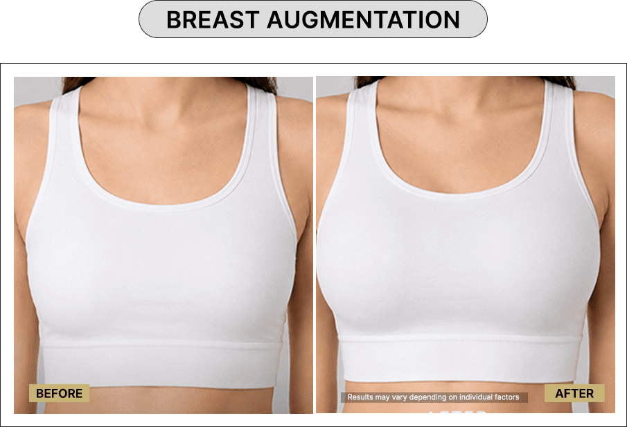 Breast Augmentation
