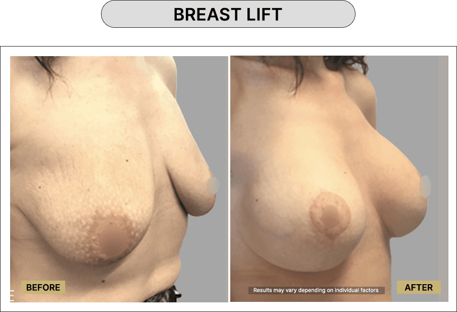 Breast lift