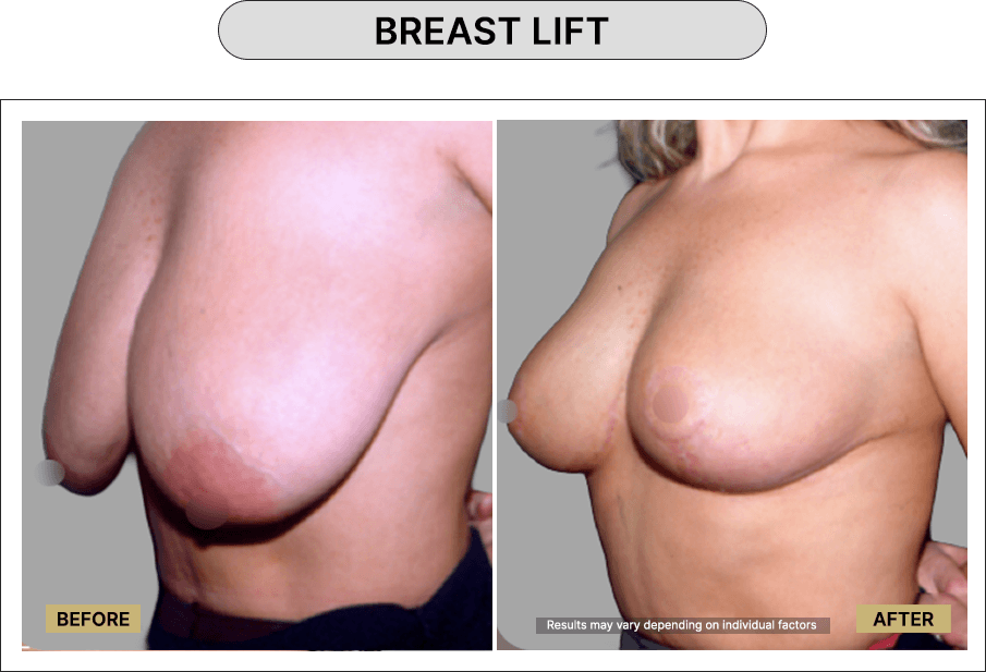Breast lift