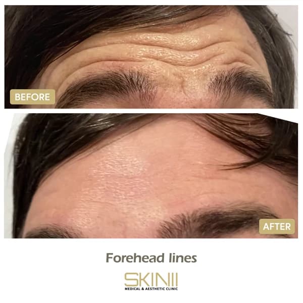 Skin111