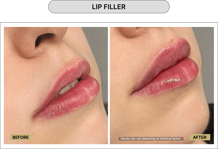 Filler