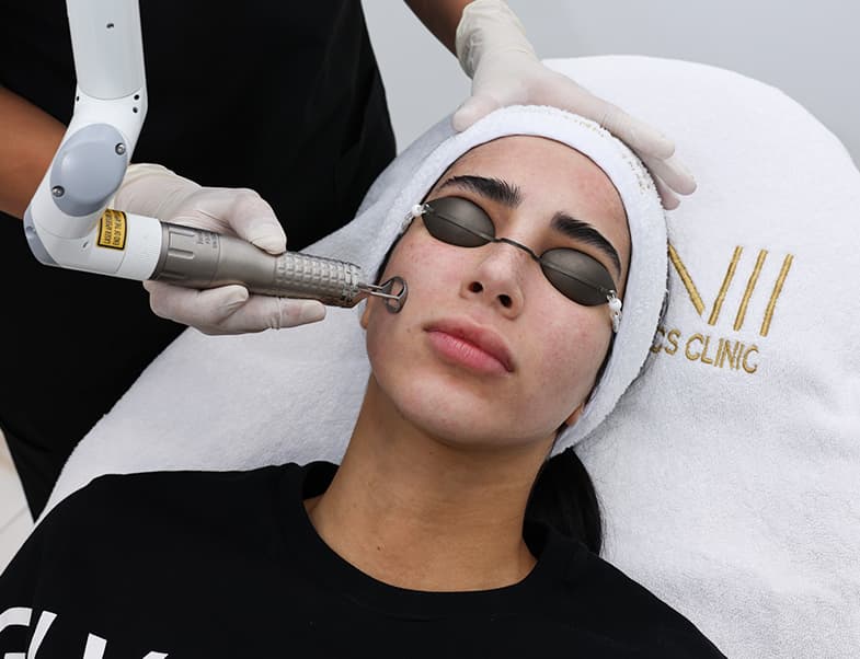 Laser hair removal