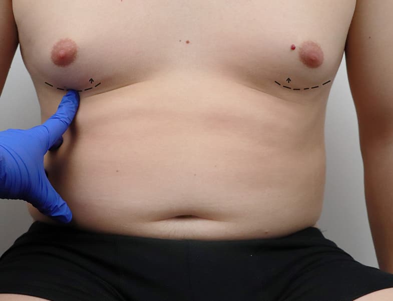 Gynecomastia