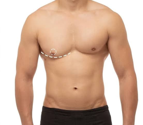 Gynecomastia