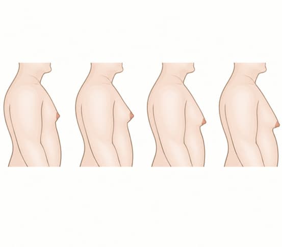 Gynecomastia