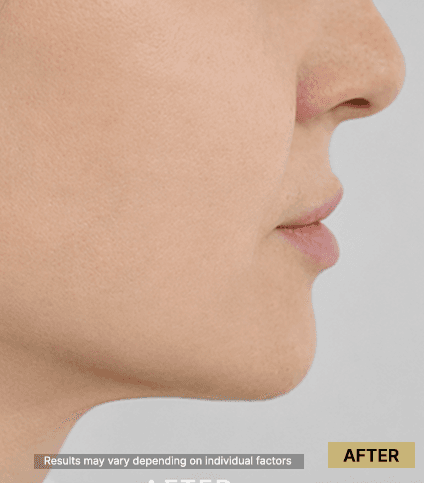 Lipolysis