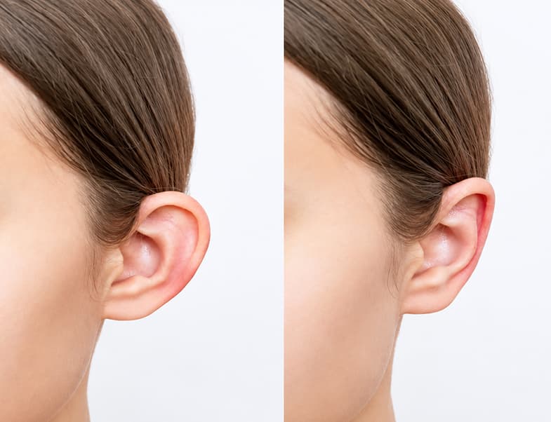 Otoplasty