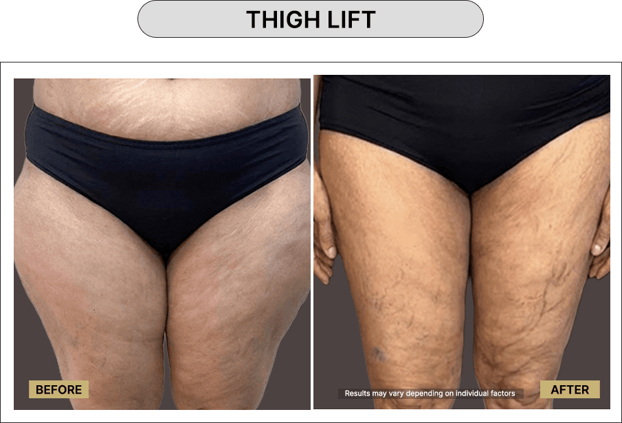 Thigh Lift