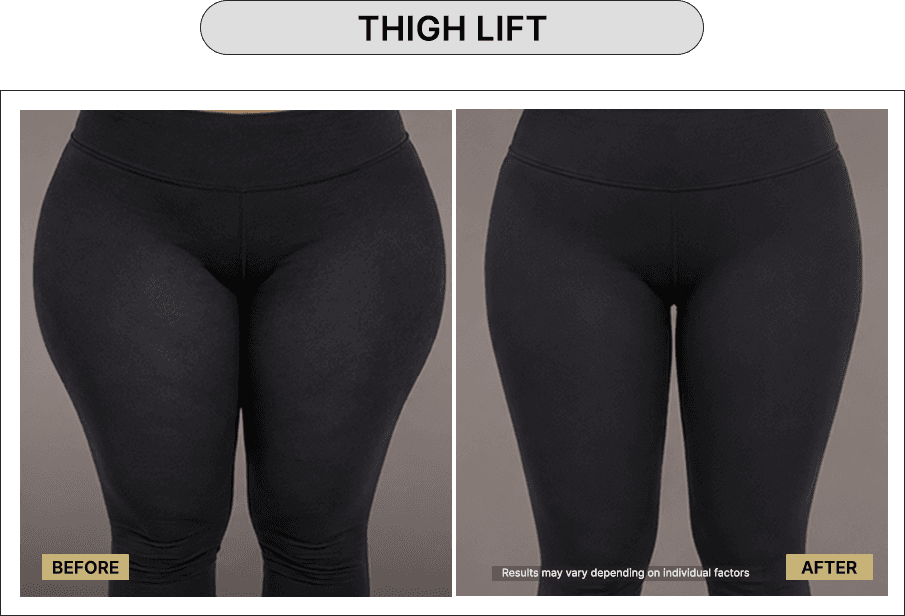 Thigh Lift