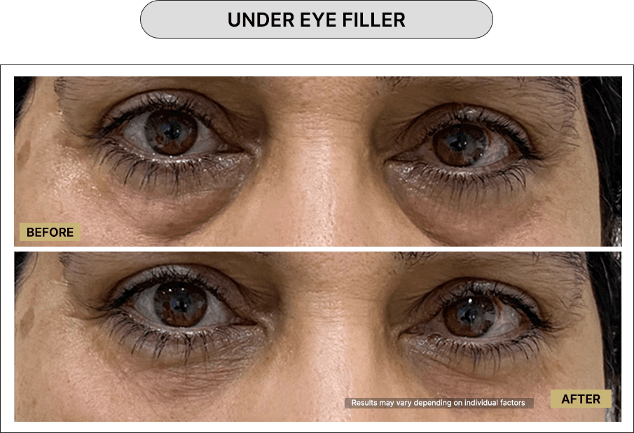 Undr eye Filler