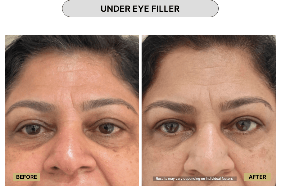 Undr eye Filler