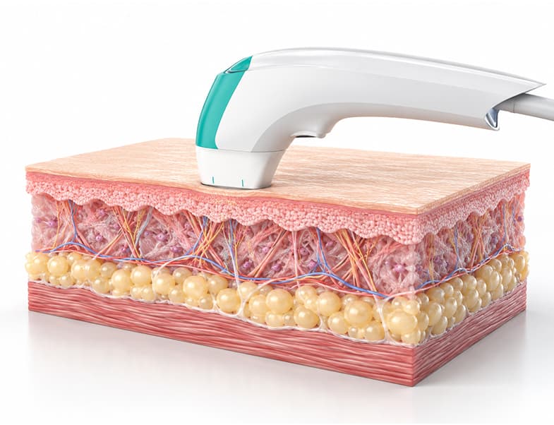 Laser hair removal