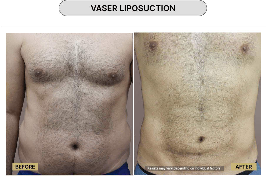 Vaser Liposuction