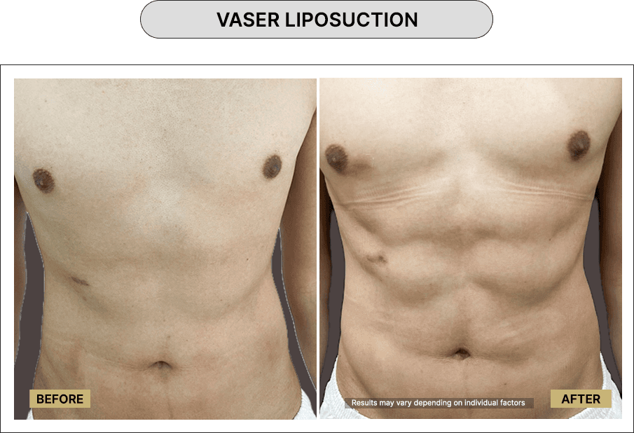 Vaser Liposuction