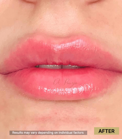 Lip Correction