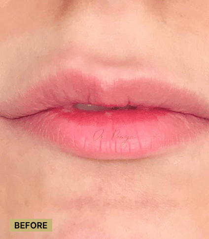 Lip Correction