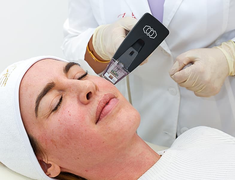 Laser hair removal