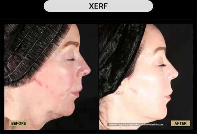 XERF