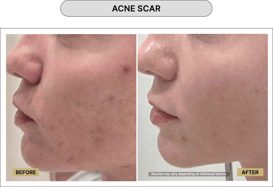 Acne Scar