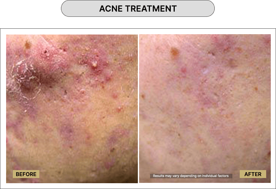 Acne Treatment