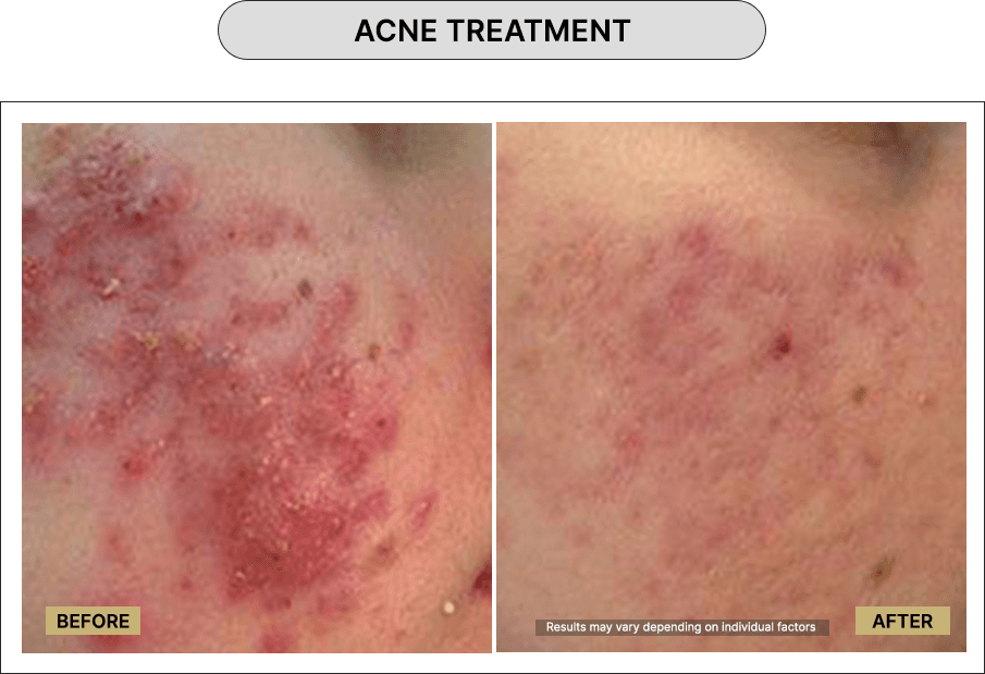 Acne Treatment