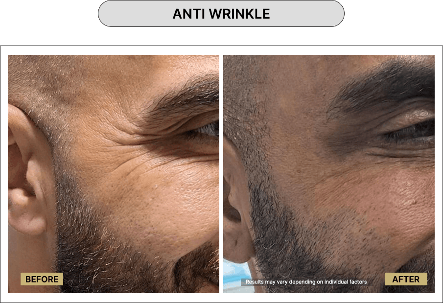 Anti wrinkle