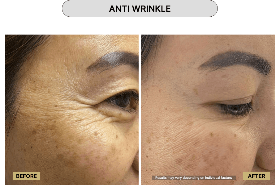 Anti wrinkle