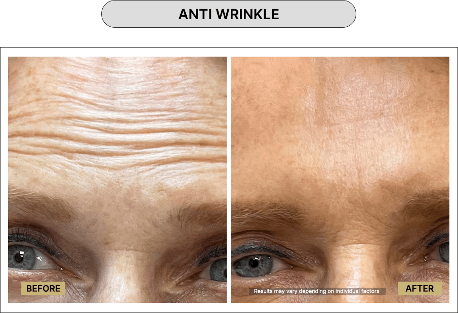 Anti wrinkle