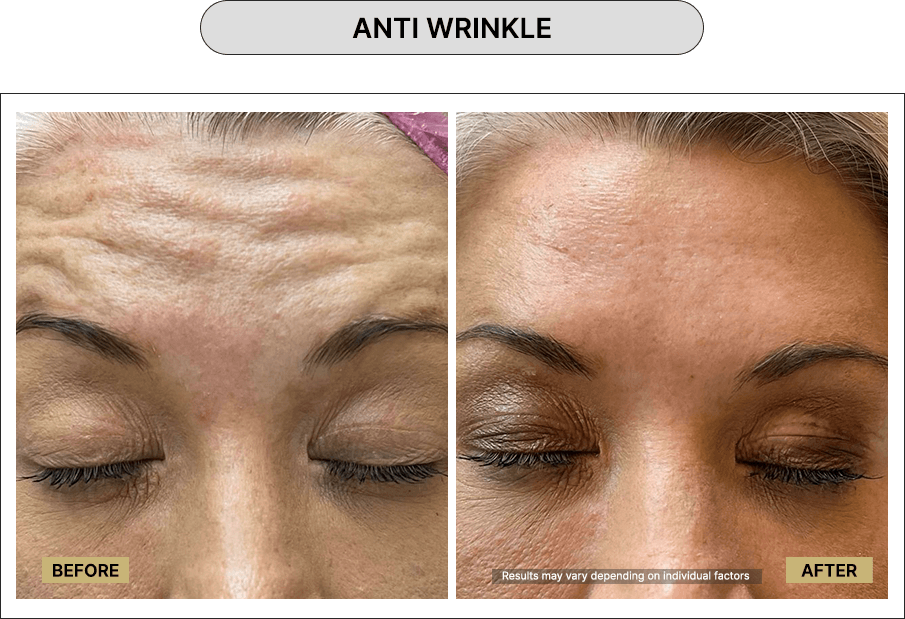 Anti wrinkle