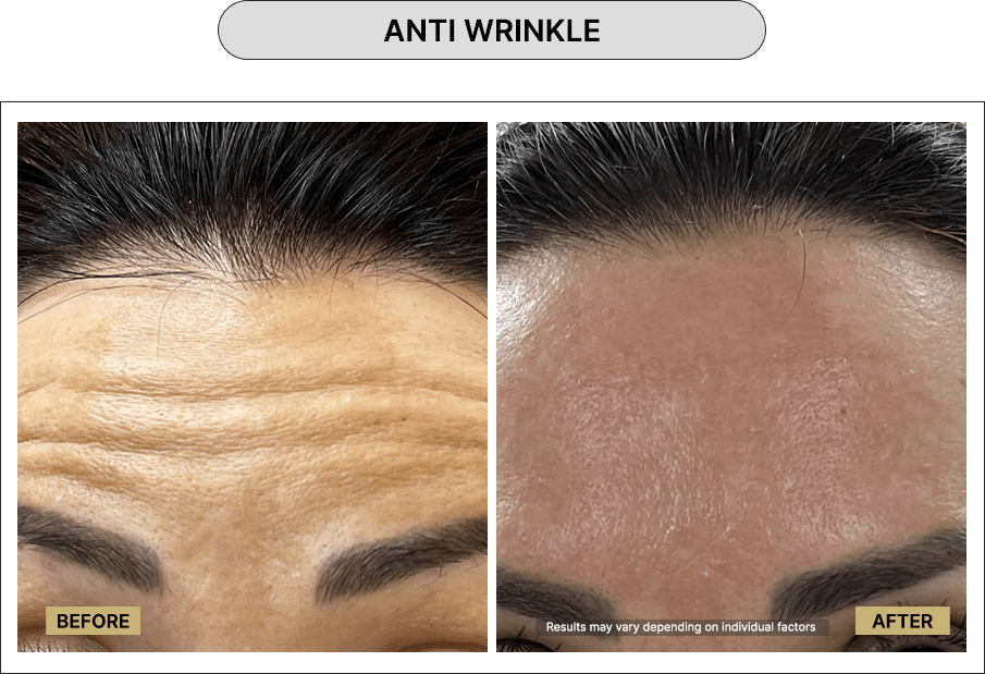 Anti wrinkle