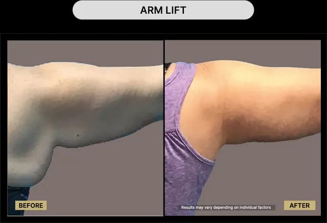 Arm Lift