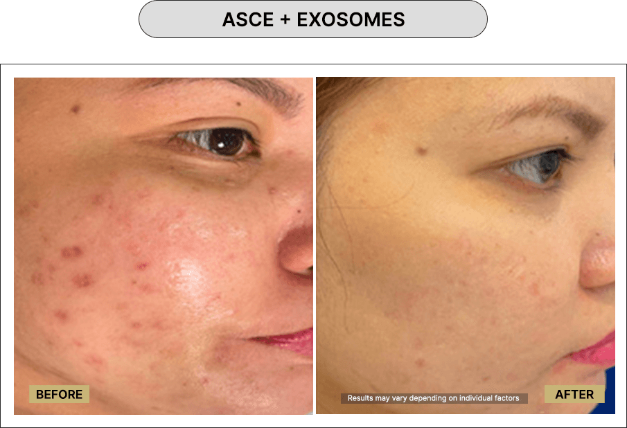 ASCE + Exosomes