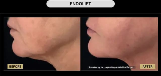 Endolift